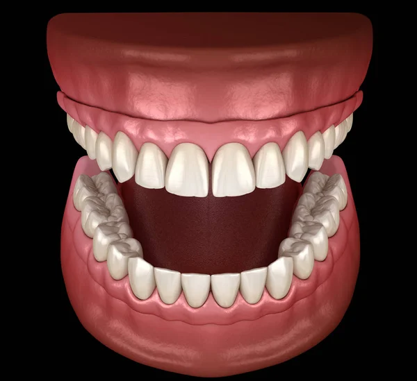 Prótese Maxilar Mandibular Com Gengiva Tudo Sobre Sistema Suportado Por — Fotografia de Stock