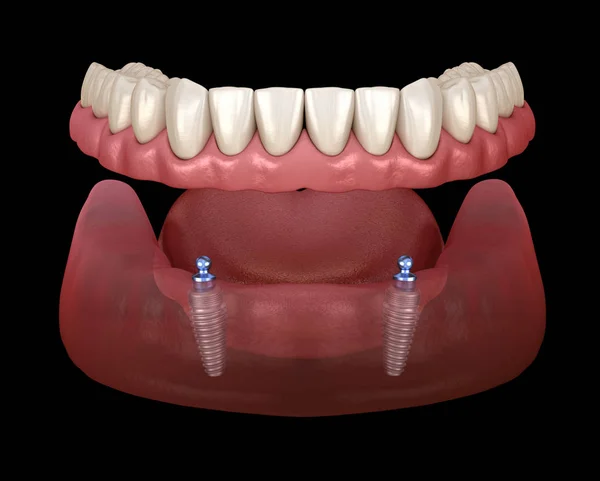 Prótese Removível Mandibular Tudo Sistema Suportado Por Implantes Com Encaixes — Fotografia de Stock