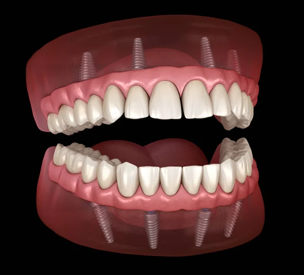 Maxillaire Mandibulaire Prothese Met Tandvlees Alles Systeem Ondersteund Door Implantaten — Stockfoto