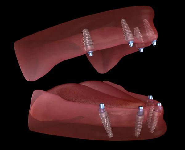 Çikletli Maxillary Mandibular Protez Hepsi Implantlarla Desteklenen Sistemde Nsan Dişlerinin — Stok fotoğraf