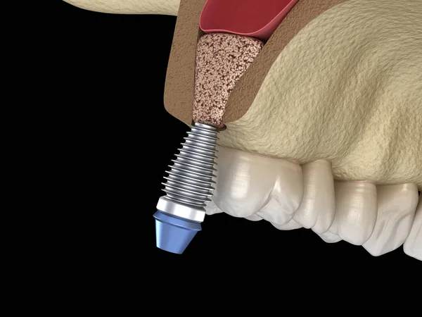 Cirurgia Elevação Sinusal Instalação Implante Ilustração — Fotografia de Stock