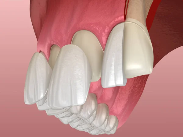 Veneer Installation Procedure Central Incisor Lateral Incisor Sliced View Illustration — Stock Photo, Image