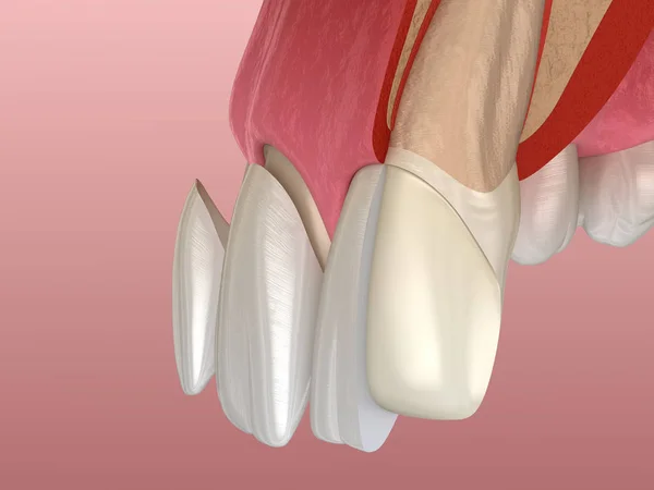 在中央门牙和侧牙上安装嵌板的程序 3D图解 — 图库照片