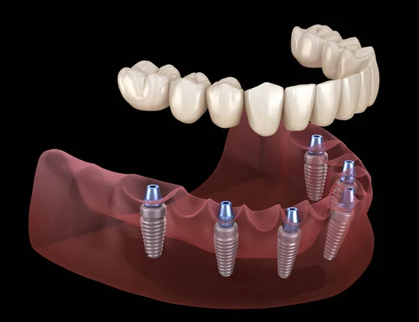 Mandibulaire Prothese Alles Systeem Ondersteund Door Implantaten Medisch Nauwkeurige Illustratie — Stockfoto