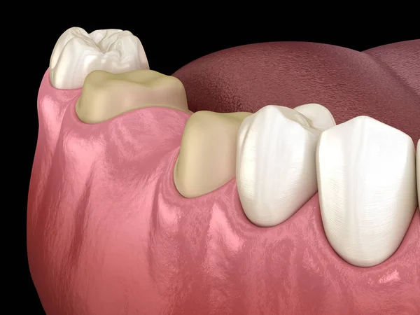 Diente Molar Premolar Preparado Para Colocación Del Puente Dental Ilustración — Foto de Stock