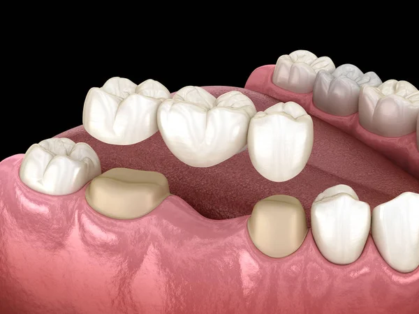 Puente Dental Dientes Sobre Molar Premolar Ilustración Médicamente Precisa Del —  Fotos de Stock