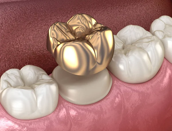 Golden Crown Molar Tooth Assembly Process Medically Accurate Illustration Human — Stock Photo, Image