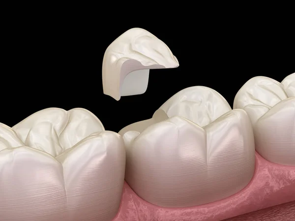 Diş Üzerinde Onlay Seramik Taç Fiksasyon Nsan Diş Tedavisi Tıbbi — Stok fotoğraf