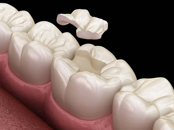 将陶瓷冠固定在牙齿上 医学上准确的人类牙齿治疗三维图像 — 图库照片