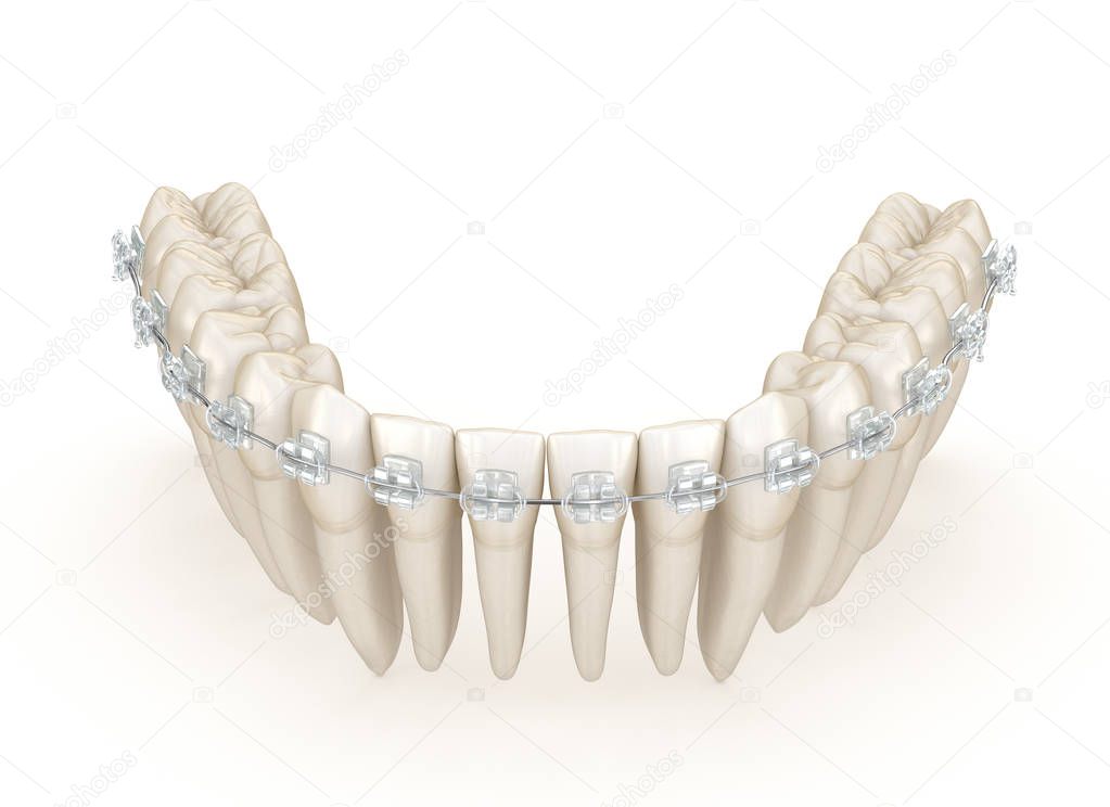 Teeth and Clear braces. 3D illustration concept