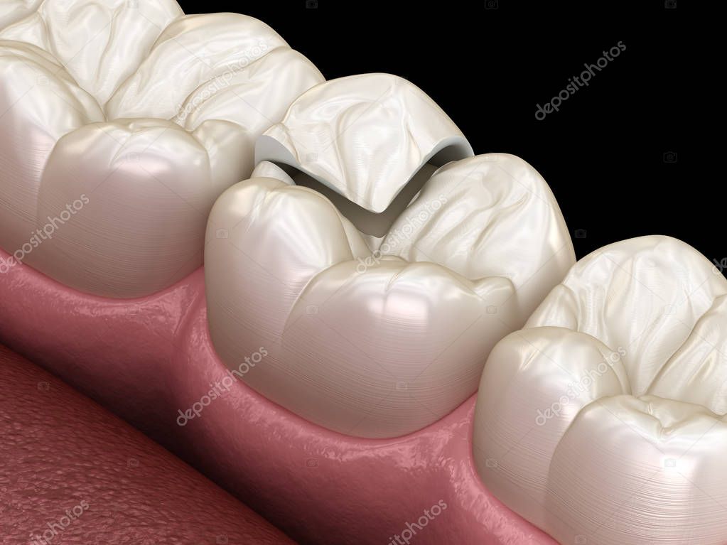 Onlay ceramic crown fixation over tooth. Medically accurate 3D illustration of human teeth treatment