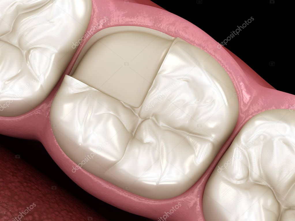 Onlay ceramic crown fixation over tooth. Medically accurate 3D illustration of human teeth treatment