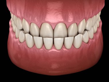 Underbite diş tıkanıklığı ( Dişlerin maloklüzyon ). Tıbbi olarak doğru diş 3d illüstrasyon