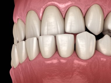 Underbite diş tıkanıklığı ( Dişlerin maloklüzyon ). Tıbbi olarak doğru diş 3d illüstrasyon