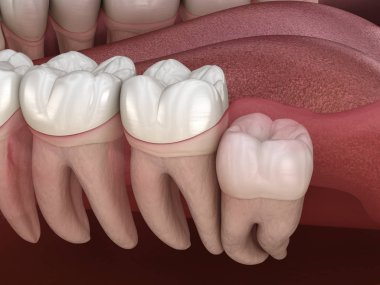 Wisdom tooth with impaction at molar tooth. Medically accurate tooth 3D illustration clipart