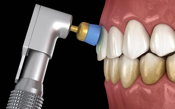 Tänder Polering Förfarande Med Professionell Borste Och Gel Medicinskt Korrekt — Stockfoto