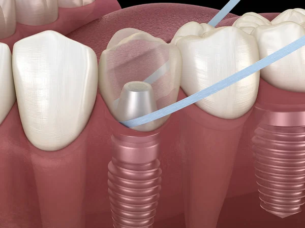 Impianto Pulizia Dei Denti Con Filo Interdentale Illustrazione Clinicamente Accurata — Foto Stock