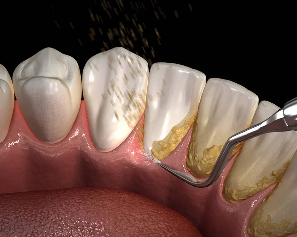 Munhygien Ultraljud Tänder Rengöringsmaskin Bort Tandsten Och Plack Medicinskt Korrekt — Stockfoto