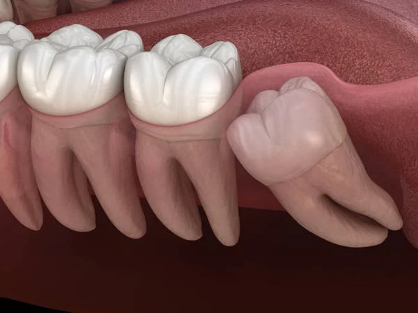 Diente Sabiduría Con Impactación Diente Molar Ilustración Dientes Médicamente Precisos — Foto de Stock