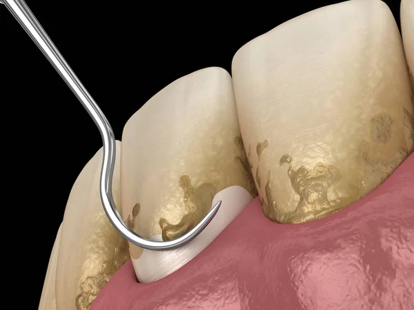 Higiene Oral Escalado Cepillado Radicular Terapia Periodontal Convencional Ilustración Médicamente — Foto de Stock