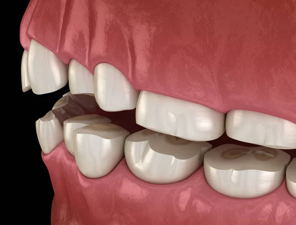 Attrition Dentaire Bruxisme Entraînant Une Perte Tissu Dentaire Illustration Dentaire — Photo