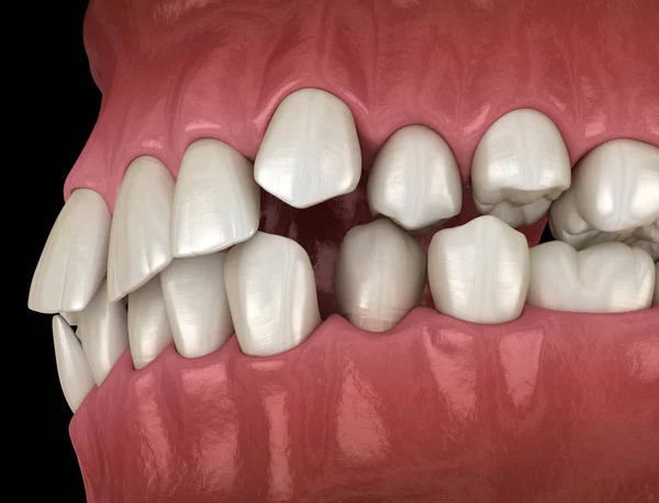 牙齿位置异常 正畸概念 医学上精确的牙齿 — 图库照片