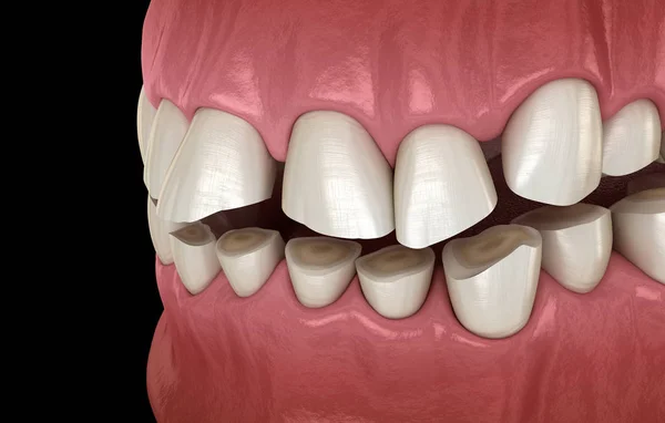 Logoramento Dentale Brussism Con Conseguente Perdita Tessuto Dentale Illustrazione Del — Foto Stock