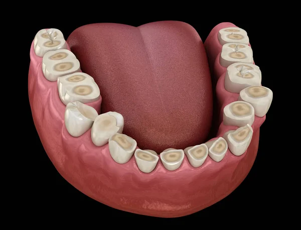 Desgaste Dental Bruxismo Que Resulta Pérdida Tejido Dental Ilustración Dientes —  Fotos de Stock
