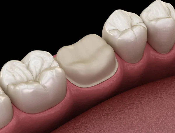 Bereide Molaire Tand Voor Tandheelkundige Kroon Plaatsing Medisch Accurate Illustratie — Stockfoto