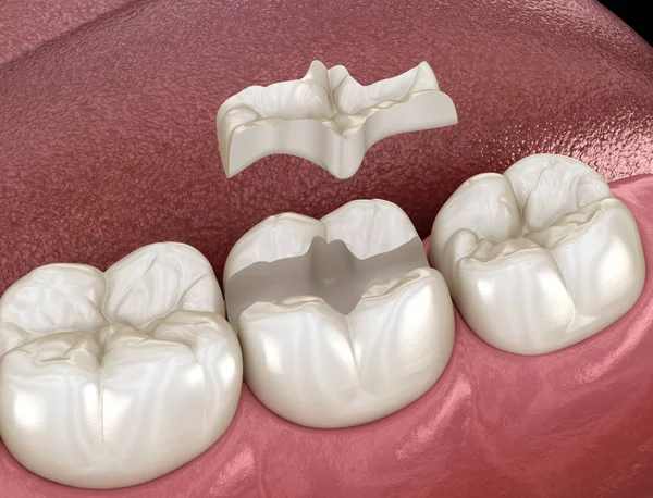 Intarsio Fissaggio Corona Ceramica Sopra Dente Illustrazione Clinicamente Accurata Del — Foto Stock