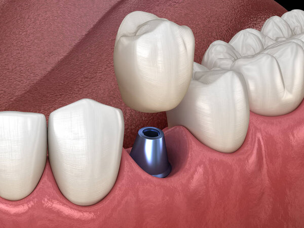 Premolar tooth recovery with implant. Medically accurate 3D illustration of human teeth and dentures concept