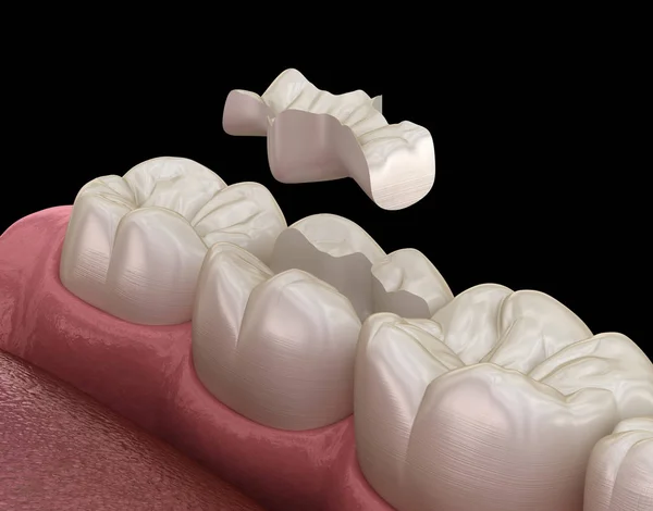 Intarsio Fissaggio Corona Ceramica Sopra Dente Illustrazione Clinicamente Accurata Del — Foto Stock