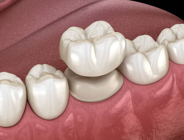 Preparated molar tooth for dental crown placement. Medically accurate 3D illustration