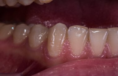 Sağlıklı insan premolar dişler yakın görünümü