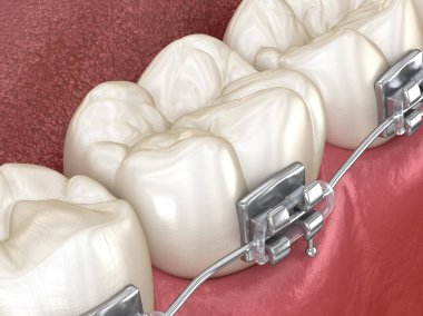 Metal telli sağlıklı dişler, Macro manzaralı. Tıbbi olarak doğru olan 3 boyutlu diş illüstrasyonu