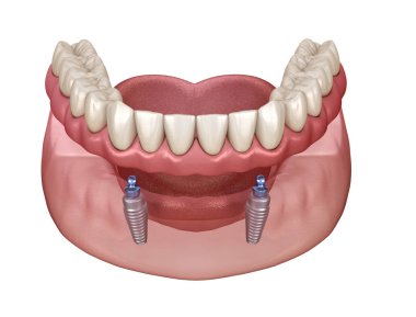 Mandibular removable prosthesis All on 2 system supported by implants with ball attachments. Medically accurate dental 3D illustration clipart