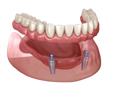 Alt çene çıkarılabilir protez. Hepsi top eklentili implantlar tarafından desteklenen 2 sistemde. Tıbbi olarak doğru olan 3 boyutlu diş illüstrasyonu