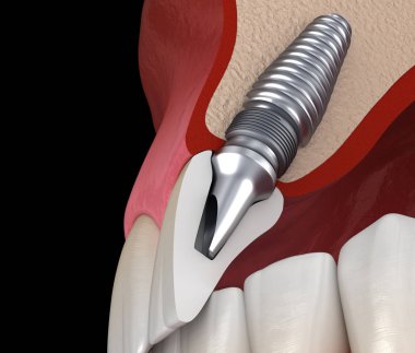 İmplant ile merkezi Kesici Tedavi İyileşmesi. Diş kavramının tıbbi olarak doğru 3d illüstrasyon