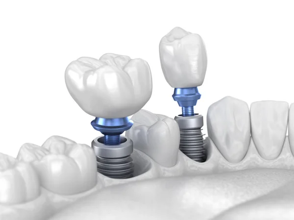 インプラント上の前歯と臼歯の歯冠設置 白の概念 人間の歯や入れ歯の3Dイラスト — ストック写真