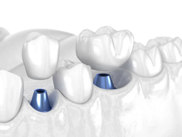 Premolar Och Molar Tand Krona Installation Över Implantat Vitt Koncept — Stockfoto