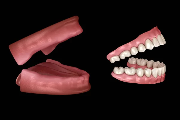 Prótesis Maxilar Mandibular Dentaduras Artificiales Ilustración Médicamente Precisa Dientes Humanos — Foto de Stock