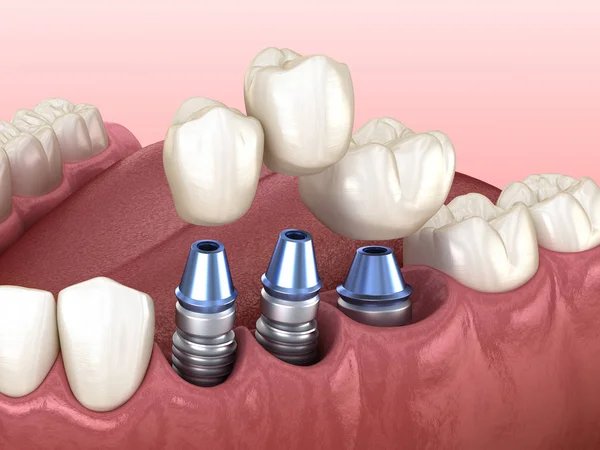 Colocación Coronas Dentales Sobre Implantes Concepto Ilustración Dientes Humanos Dentaduras —  Fotos de Stock