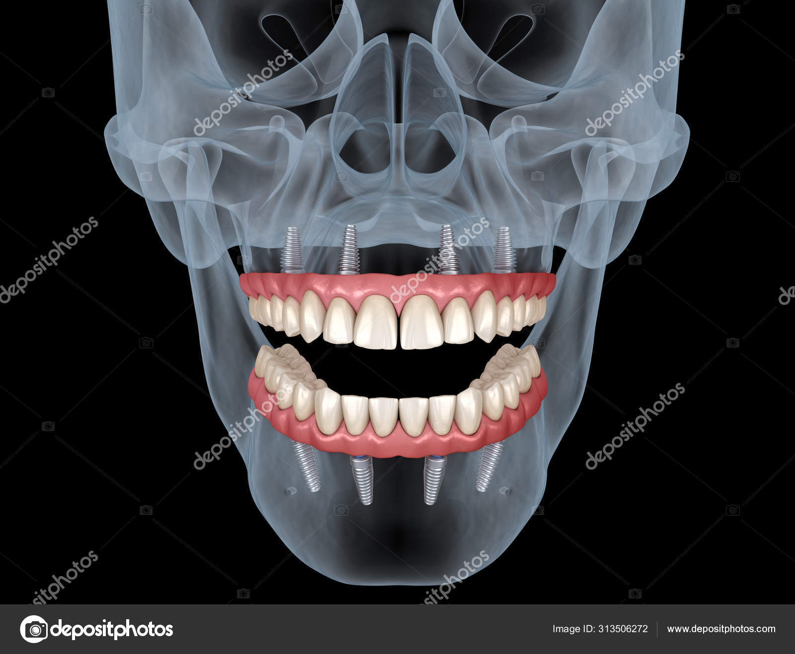 Prótese Mandibular Maxilar Tudo Sobre Sistema Suportado Por