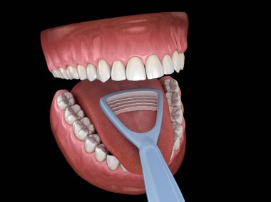 Dil temizliği - Kazıyıcı. Ağız hijyeni tıbbi olarak doğru 3d illüstrasyon.