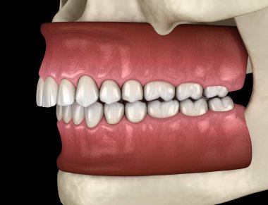 Overbite diş tıkanıklığı ( Diş maloklüzyonu ). Tıbbi olarak doğru diş 3d illüstrasyon