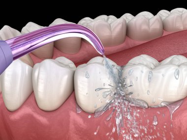 Tahriş edici, su dişleri temizliği. Ağız hijyeni tıbbi olarak doğru 3d illüstrasyon.