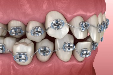 Anormal diş pozisyonu ve metal parantez tretament. Tıbbi olarak doğru diş 3d illüstrasyon