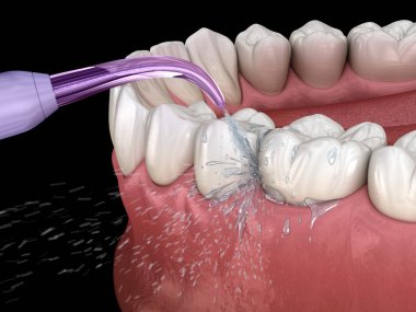 Tahriş edici, su dişleri temizliği. Ağız hijyeni tıbbi olarak doğru 3d illüstrasyon.