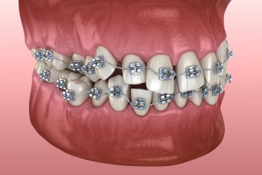 Anormal diş pozisyonu ve metal parantez tretament. Tıbbi olarak doğru diş 3d illüstrasyon