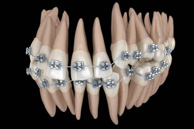 Anormal diş pozisyonu ve metal parantez tretament. Tıbbi olarak doğru diş 3d illüstrasyon